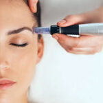 Morpheus8 vs Microneedling