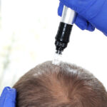 Microneedling for hair growth
