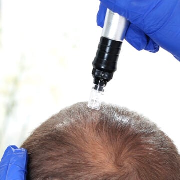 Microneedling for hair growth